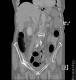 CT colon 27